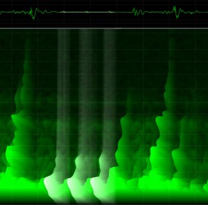 Audible atrial flutter sound: two rare cases